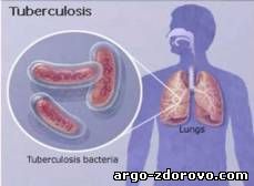 ЭМ-Курунга и лечение туберкулеза